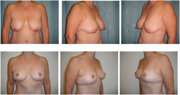 Seven Remedies For Sagging Breasts
